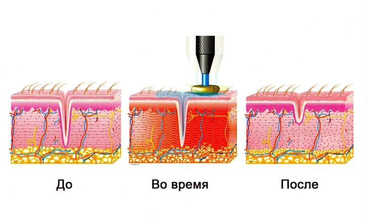 рф лифтинг схема